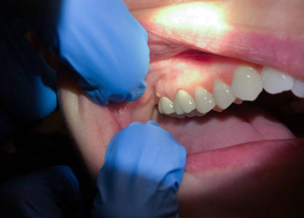 Emergency Dental Filling Replacement in MT